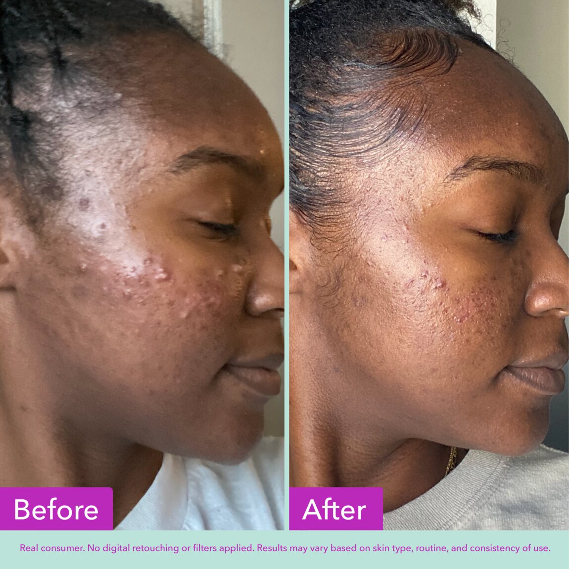 acne-foaming-cleanser-j6 zb_p.jpg